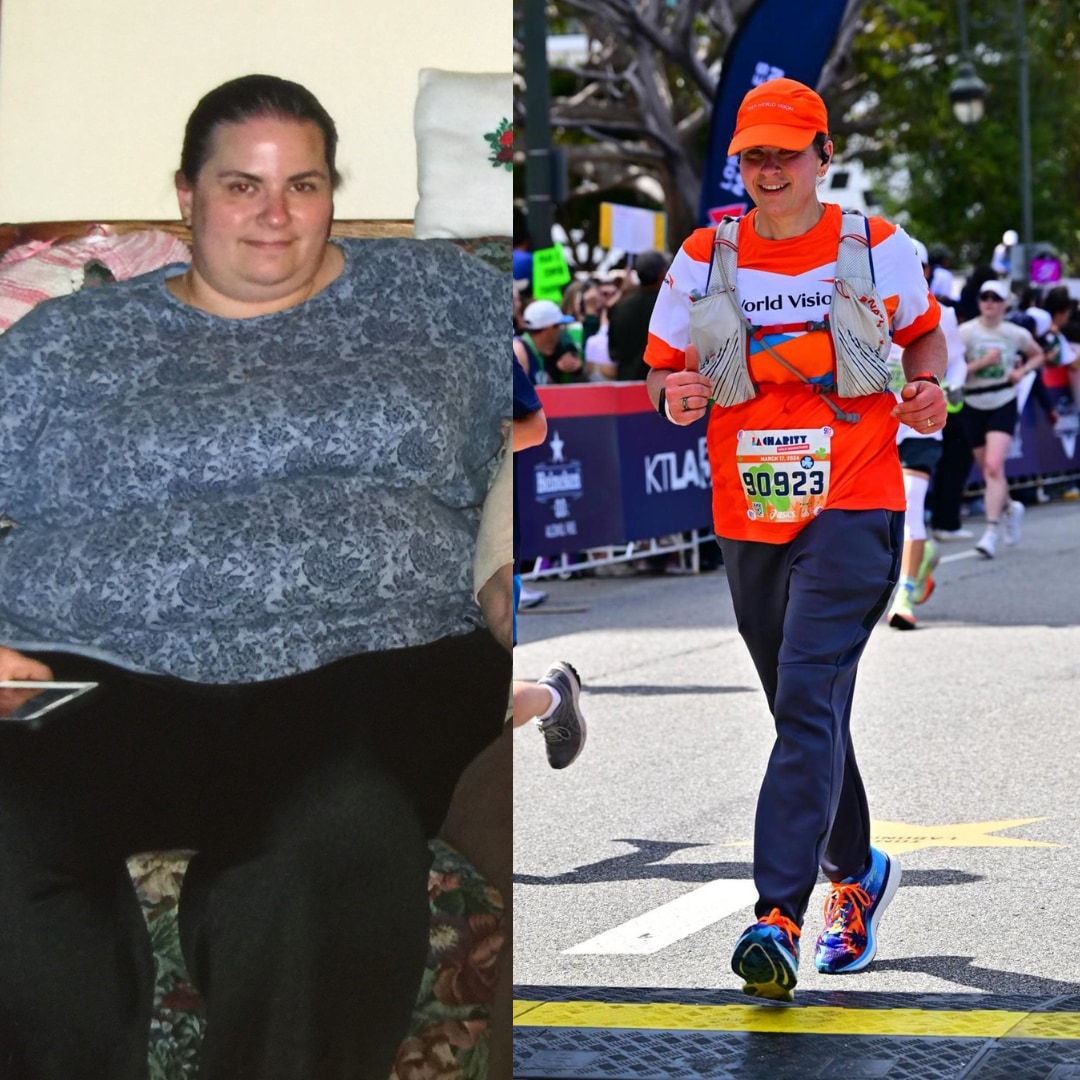 Photo of bariatric patient before and after