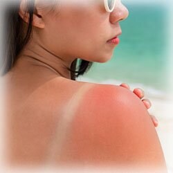 Photo of Woman with a Sunburn 