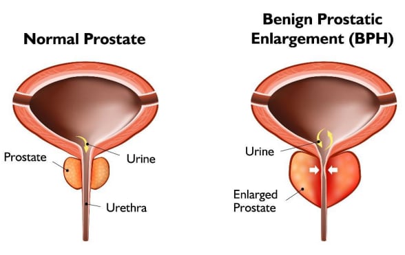 Graphic showing normal and enlarged prostate