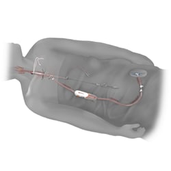 Illustration of the TCAR device in use