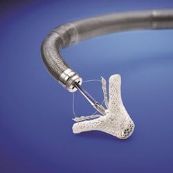 Image of the Mitraclip device