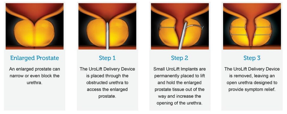 Graphic that shows the Urolift steps