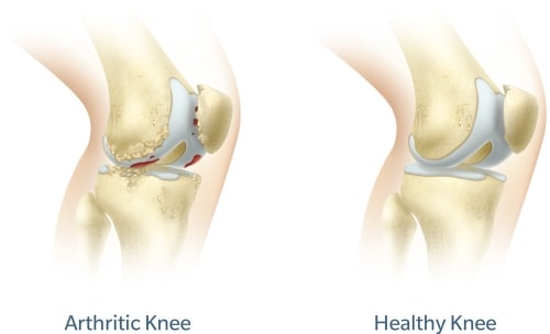 Arthritic vs Healthy Knee Image